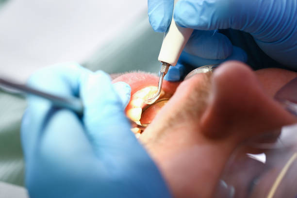 Best Emergency Wisdom Tooth Extraction in Shawneeland, VA