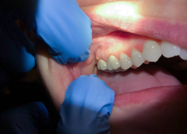 Best Emergency Care for Gum Disease in Shawneeland, VA